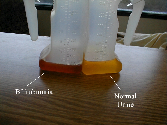 bilirubin-crystals-in-urine-from-a-patient-with-alcoholic-cirrhosis-r