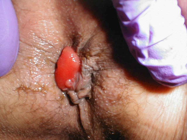 Prolapsed Rectal Mucosa