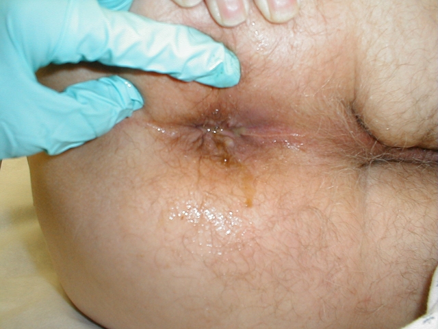 Squamous Cell Cancer of the Rectum