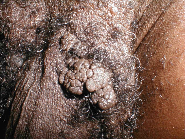 Penile Concyloma Acuminata 2