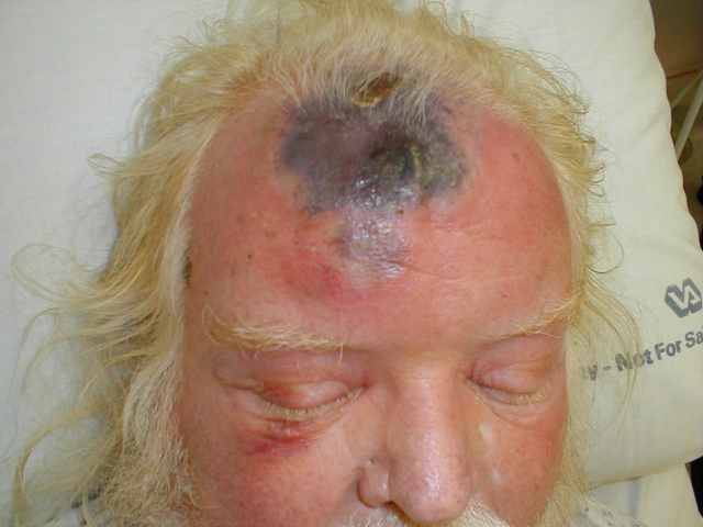 Hematoma of the Scalp with Cellulitis