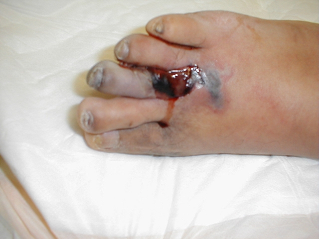 Diabetic Foot Infection 2 (Cellulitis with Gangrene)