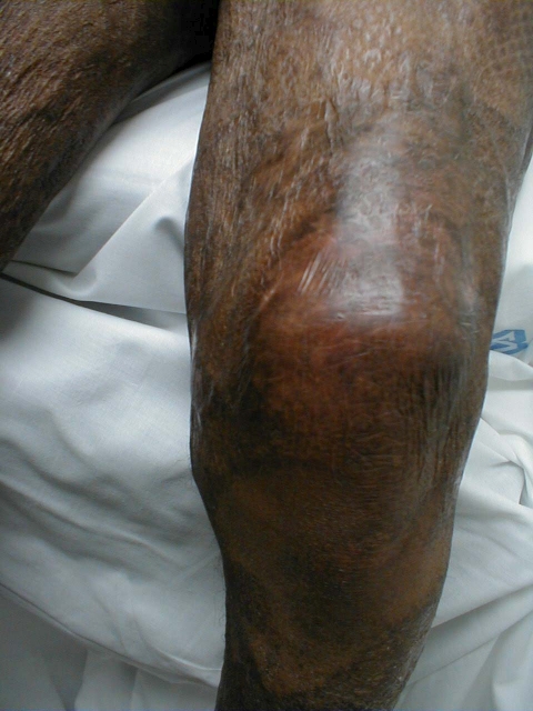 Gout of the Knee