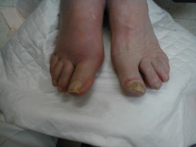 Gout of the Great Toe