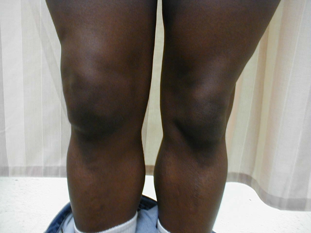 Right Knee Effusion