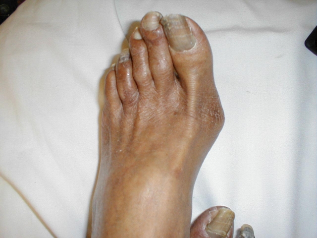 Gangrene of the Toe