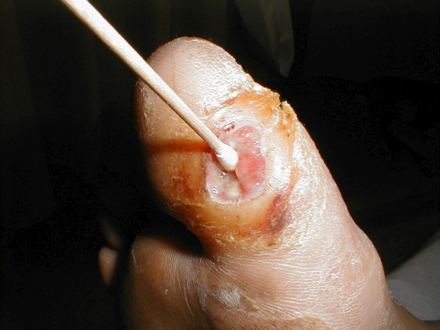 Neuropathic Ulcer with Osteomyelitis