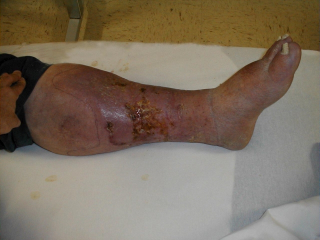 Venous Ulcer and DVT