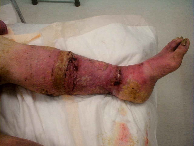 Venous Insufficiency With Cellulitis and Ulceration