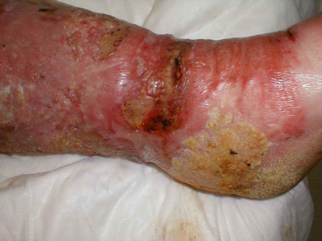 Venous Insufficiency With Cellulitis and Ulceration