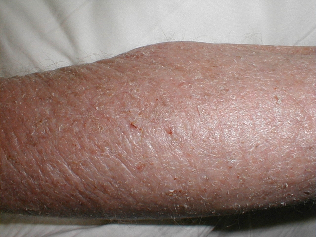 Atopic Dermatitis 2