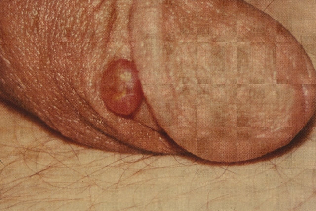 Basillary Angiomatosis