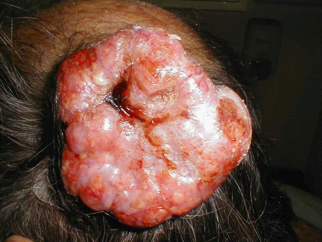 Basal Cell Carcinoma 9 (Massive)