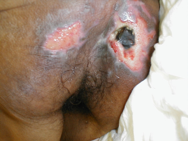 Decubitus Ulcer (Stage 2 and 3)