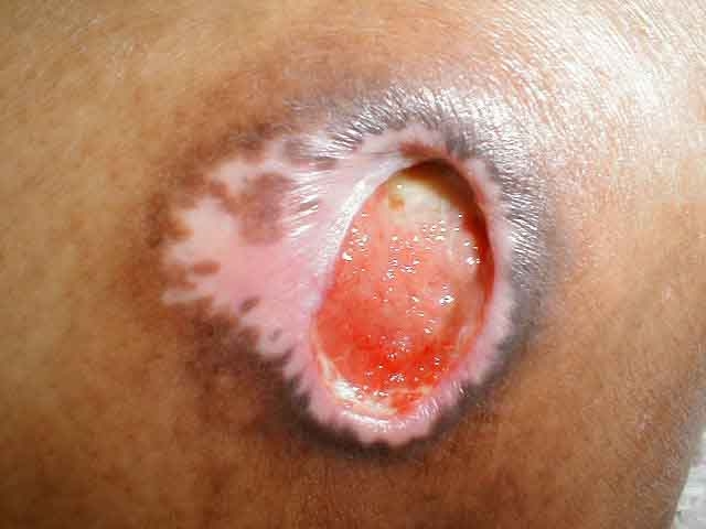 Decubitus Ulcers-Progression from Stage 4 to Healed