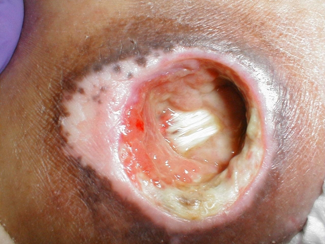 Decubitus Ulcers-Progression from Stage 4 to Healed