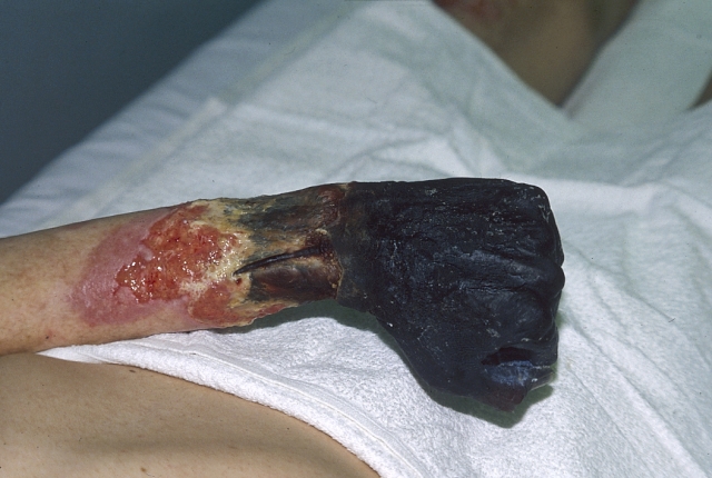 Gangrene (Hand)