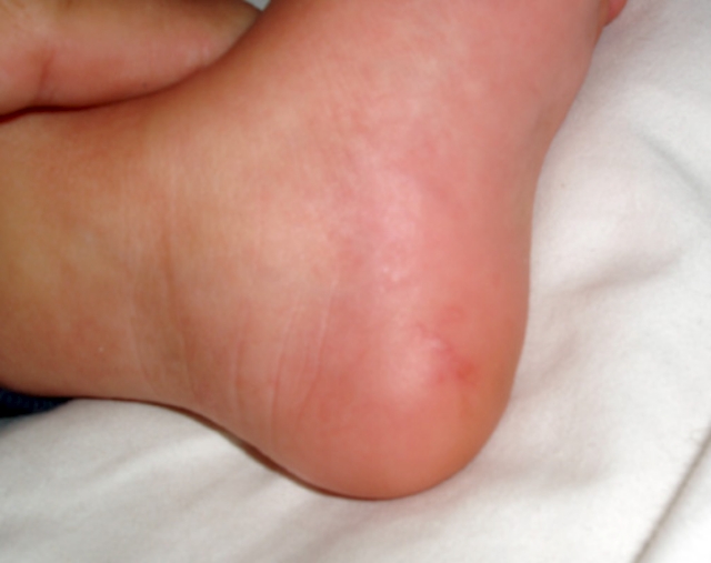 Hand, Foot, and Mouth Disease (Coxsackie Virus)