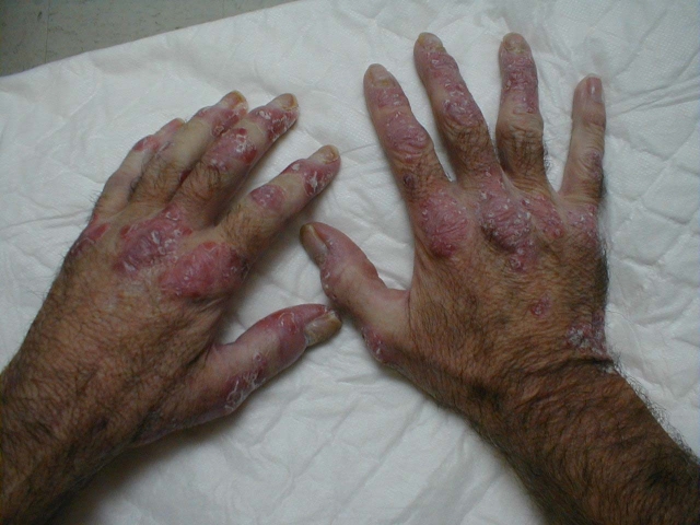 Psoriasis (Hands)