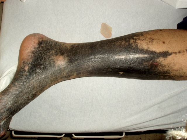 Minocycline Induced skin Discoloration