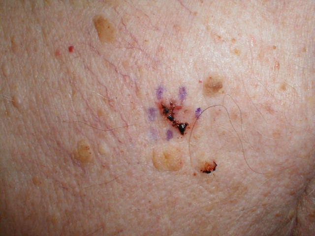 Basal Cell Carcinoma 4 (Pigmented)