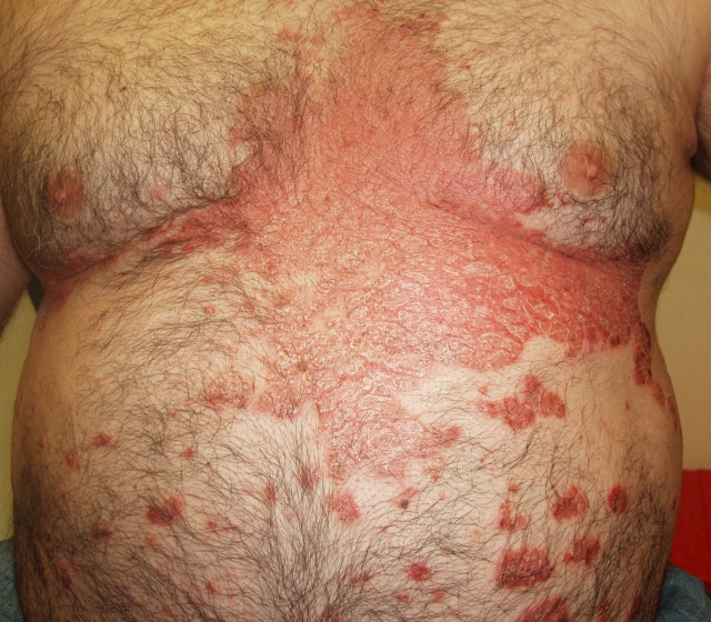 Psoriasis (Back and Chest)