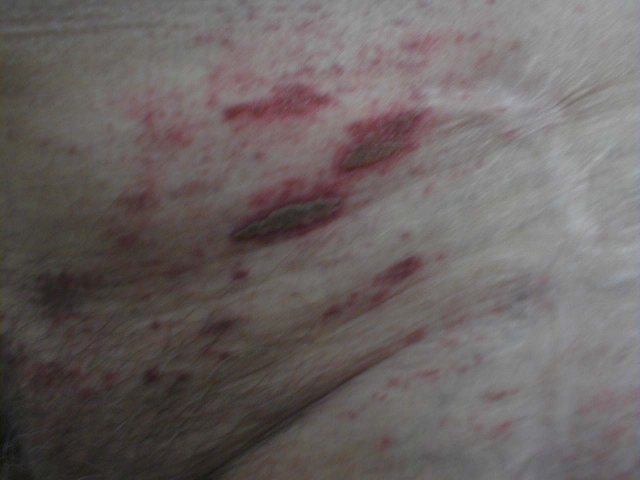 Herpes Zoster 1