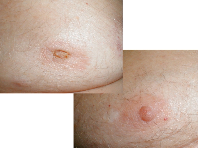 Nipple Retraction Secondary to Breast Cancer