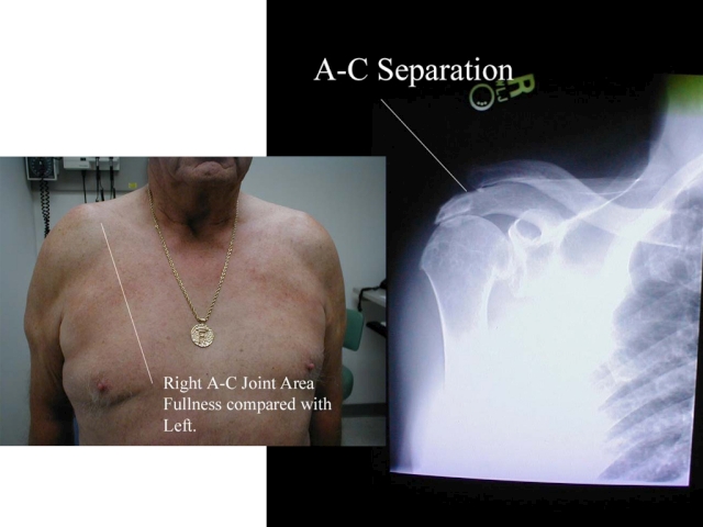 A-C Joint Separation