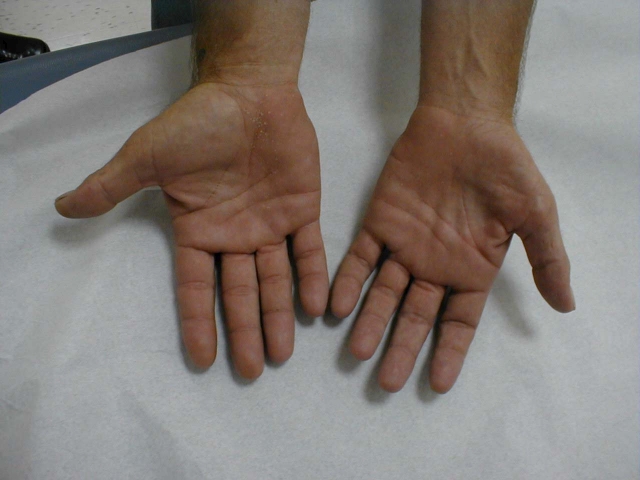 Hand Muscle Wasting