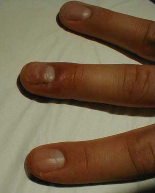 Paronychia-Middle Finger
