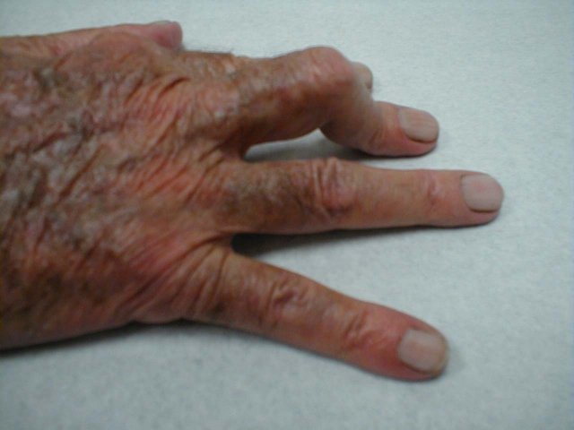 Boutonniere Deformity of the Finger