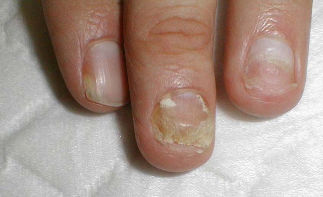 Onychomycosis of the Finger