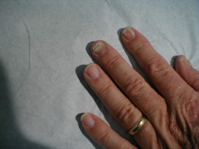 Onychomycosis of the Finger 2