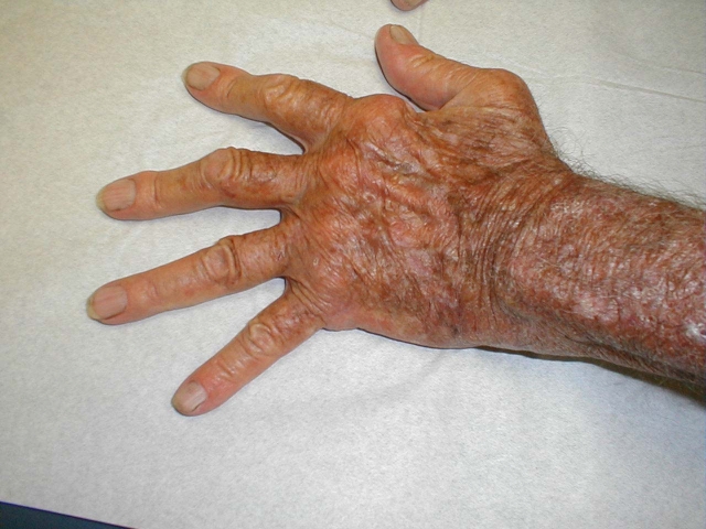 Rheumatoid Arthritis of the Hand 2