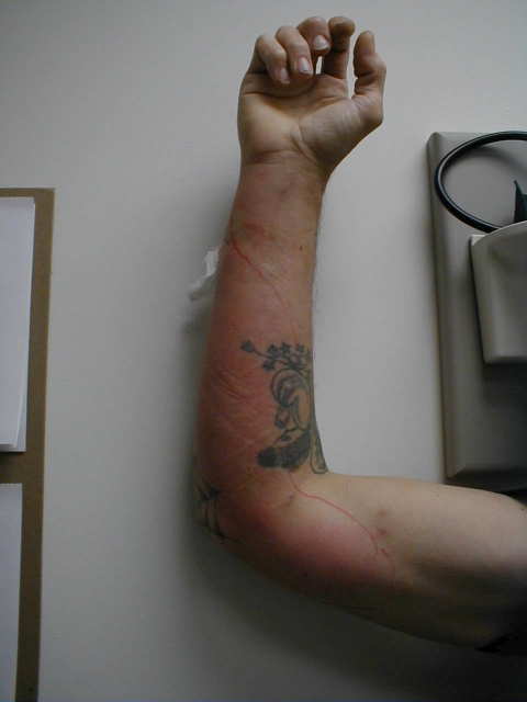 Lymphangitis of the Arm 2