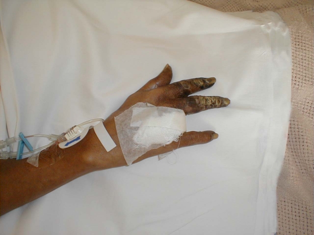 Peripheral Vascular Disease of the Hand