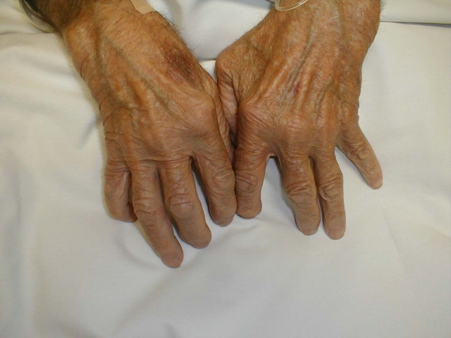 Rheumatoid Arthritis of the Hand 1