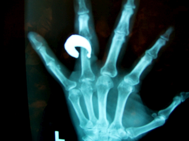 Osteomyelitis of the Finger (secondary to foreign body)