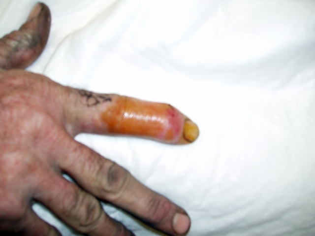 Septic Arthritis (finger)