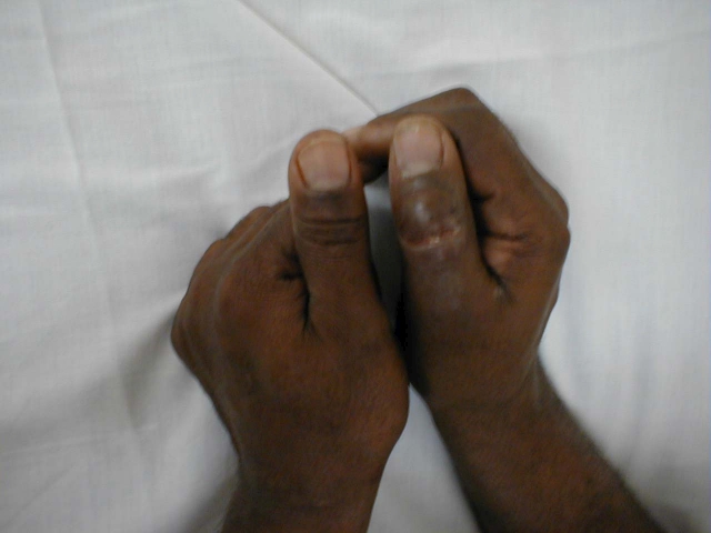 Cellulitis of the Thumb