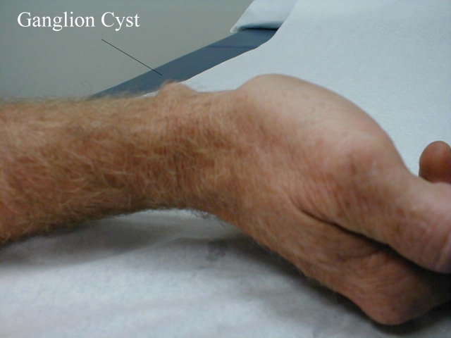 Ganglion Cyst of the Wrist