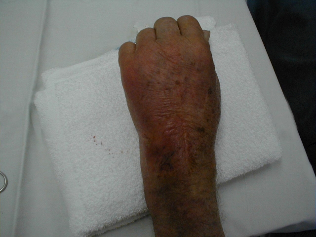 Gout of the Wrist