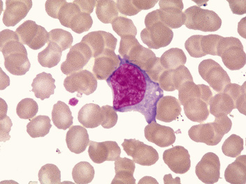 what are atypical lymphocytes