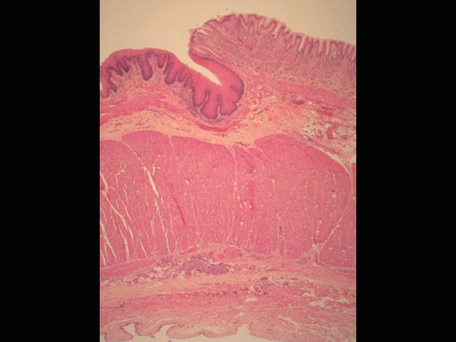 Gastro-esophageal junction