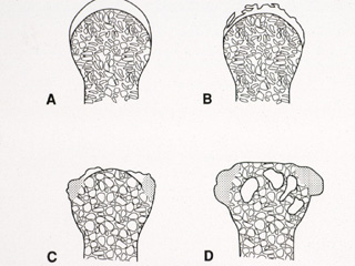 Degenerative joint disease, diagram