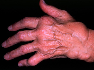 Rheumatoid arthritis, clinical photo