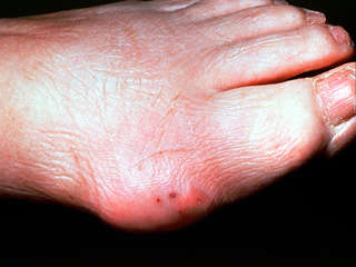 Gouty arthritis, clinical photo