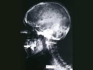 Multiple myeloma, radiograph