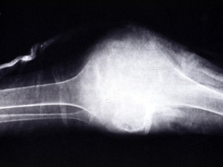 Osteosarcoma, radiograph
